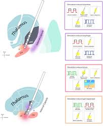 Image result for Essential Tremor
