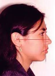 EVALUACION DEL PERFIL FACIAL DE TEJIDOS BLANDOS CON EL ANALISIS DE POWELL  EN 364 ESCOLARES DE 6 A 13 AÑOS CON CLASE I MOLAR DE