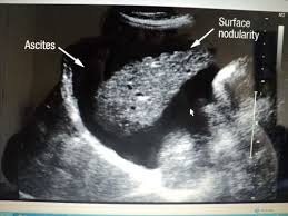 What week is the highest risk of miscarriage? Liver Pathology Ultrasound Images Ultrasound Sonography Diagnostic Medical Sonography Ultrasound