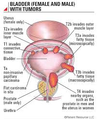 Bladder cancer is often found because of signs or symptoms a person is having. Patient Resource Publishing Bladder Cancer Staging
