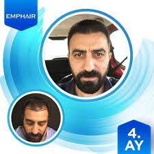 Sac Ekimi Sonrasi Hair Transplant Price Hair Transplant Treatment
