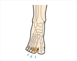Image result for Toe Fracture