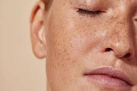Image result for Freckled skin