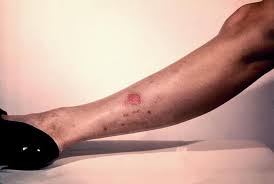 Image result for große winkelspinne biss haut reaktion