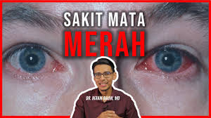 Maybe you would like to learn more about one of these? Punca Dan Rawatan Sakit Mata Merah Acute Conjunctivitis Tips Dan Cara Pakai Ubat Titis Mata Youtube