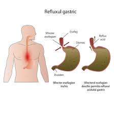 Hernia hiatala reprezinta trecerea unei parti a stomacului din abdomen in torace prin orificiul diafragmatic. Colonhelp Reduce Aciditatea GastricÄƒ Colonhelp Ro