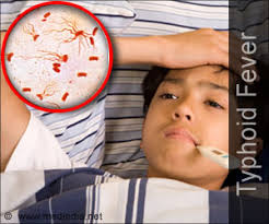 Image result for typhoid fever IMAGE