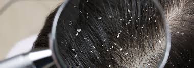 Image result for lice vs dandruff
