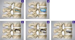 Wirbelsaulen Operation Gelenk Klinik De