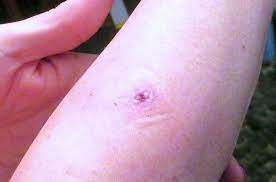 However, the researchers can only hypothesize on the mechanisms driving this association. Unsafe Mole Removal At Home Skin Care Network
