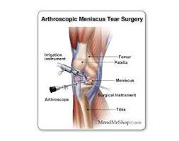 Surgical repair of the meniscus is often utilized through arthroscopic surgery. Knee Arthroscopy With Meniscal Repair Includes Implants Hardware St George Surgical Center