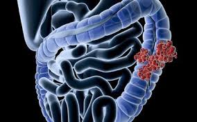 Bowel cancer is unfortunately very common, being the third most common malignancy after breast and lung cancer. Colon Cancer In Women Signs Symptoms And Complications
