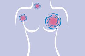 We did not find results for: Where Does Breast Cancer Spread Health Essentials From Cleveland Clinic