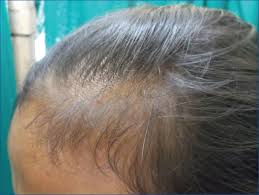 The transition phase lasts about two weeks. Indian Journal Of Dermatology Venereology And Leprology Telogen Effluvium