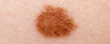 What does skin cancer look like? Skin Cancer Detection Technology Promises Early Diagnosis Myvmc