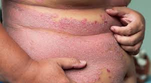 It's the fourth most common cause of risk factors for liver cancer include hepatitis b and c (hepatitis is the inflammation of the liver) most people in the early stages of primary liver cancer do not experience any signs or symptoms, said dr. Fatty Liver Disease First In Psoriasis