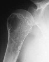 Image result for Leiomyosarcoma