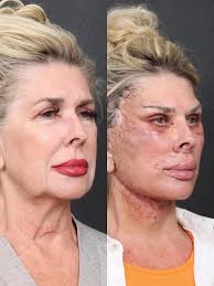 TRUST THE PROCESS: Here is Charlene, who will be 70 years young this year  and you can see her 3 days after surgery and 9 months after surgery. She is  looking fabulous.