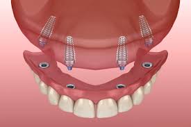 Image result for dentures