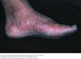 Image result for Tinnea vesiculosa