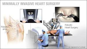 Dear Mayo Clinic Is Minimally Invasive Heart Surgery To Repair A Mitral Valve A Safer Option Than Open Heart Su Mitral Valve Mitral Valve Repair Heart Surgery