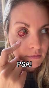 I hope this helps at least one person to not have to experience this. I had  no idea this solution even existed. 😫 #contacts #psa #healthtips #ouch  #cornealabrasion #burnedeyes #cleareyes