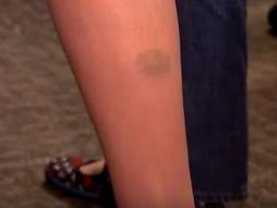 Dan pre nemojte piti kafu posle 19 sati. Modrice Posle VaÄ'enja Krvi Nisu Retkost Laborantkinja Otkriva Da Li Su Opasne I Kako Da Ih Saniramo Telegraf Rs