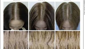 Spironolactone (aldactone) is used for fluid retention, heart failure, primary aldosteronism. Ladies Listen Up Here Are The Top 15 Reasons Your Hair Might Be Falling Out