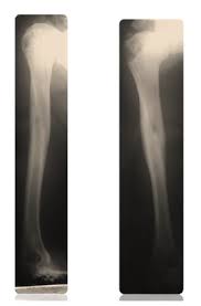 1,666 humerus nail products are offered for sale by suppliers on alibaba.com. Open Access Journals Online Scientific Academic Journals Publications Arc Journal Of Orthopedics