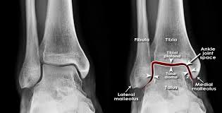 Image result for Ankle XRay