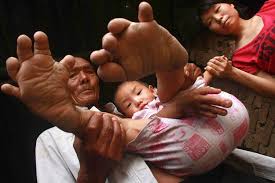 Gigantism is a pediatric disorder resulting from excess growth hormone secreted by the pituitary by definition, gigantism must occur during childhood before the growth plates in the long bones of the. Man Suffering From Local Gigantism Dubbed As Devil By His Own Family Newsgram