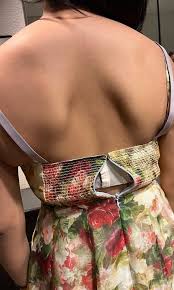 Image result for Winged Scapula