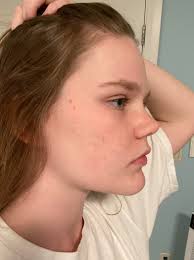 Recension] Spironolakton är livsförändrande. Började ta 2 tabletter varje  dag den 20 januari. De två första bilderna togs den dag jag började, de två  andra togs just nu. Det är bokstavligen det