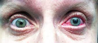 Glaucoma is the second leading cause of blindness Acute Angle Closure Glaucoma Nejm