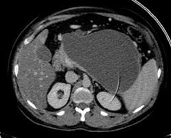 Clinical approach to pancreatic cystic lesions