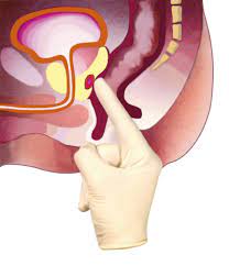 Bei der prostata handelt es sich um die vorsteherdrüse, ein männliches. Digitale Rektale Untersuchung Dru Prostata De