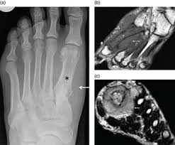Bone cancer destroys normal bone tissue. Chapter 18 Malignant Tumors Of The Foot And Ankle Musculoskeletal Key