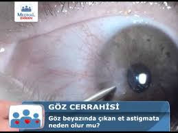 Goz Beyazinda Cikan Et Astigmata Neden Olur Mu Op Dr Levent Akcay Youtube