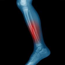 Image result for Fracture