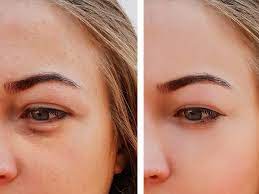 Puffy Eyes: The Causes And How To Get Rid Of Them