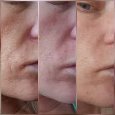 Also, it is important that patients never mix their tretinoin with products that contain glycolic acid or benzoyl peroxide. Retin A Reviews Was It Worth It Realself