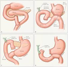 Whipple Procedure In India Pancreatic Cancer Whipple Procedure India