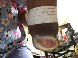 Eschar may be black, brown, or tan in appearance. Enluxtra For Any Wound Blog Enluxtra