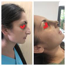 4 cât costă operația de rinoplastia? Rinoplastie Chirurgie Estetica Cluj Napoca
