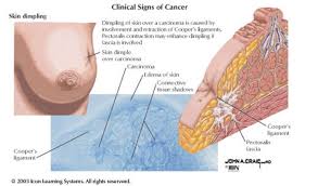 Breast cancer is most easily treated if spotted early. Breast Cancer Symptoms Saint Luke S Health System