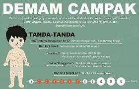 Cara ini adalah cara yang paling mudah untuk menghilangkan komedo dari wajah. Cara Guna Najlaa Untuk Demam Campak Najlaa Baby Skincare Facebook