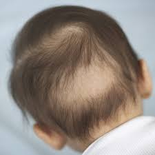 All babies will have their hair in eventually, and before you know it you'll be bribing them to let you brush their hair or planning a first haircut. Hair Loss In Babies Babycenter