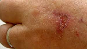Contact dermatitis usually shows up when you've been touched by a substance that triggers a reaction, like poison ivy dry skin with a glazed, parched aspect is often the first sign with irritants. Contact Dermatitis Causes Symptoms And Treatment