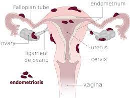 An der linden pj (1996). File Endometriosis Svg Wikimedia Commons