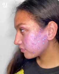 Getting Lights Tattooed On My Face